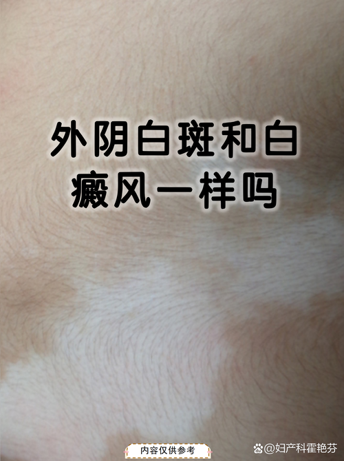 白斑的10种症状图,白斑怎么治才能根除吗